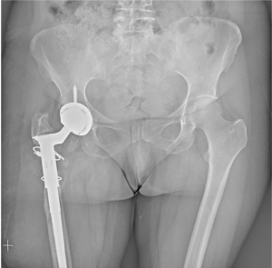 Prótese da anca. A fisioterapia aquática como grande mais-valia na recuperação.